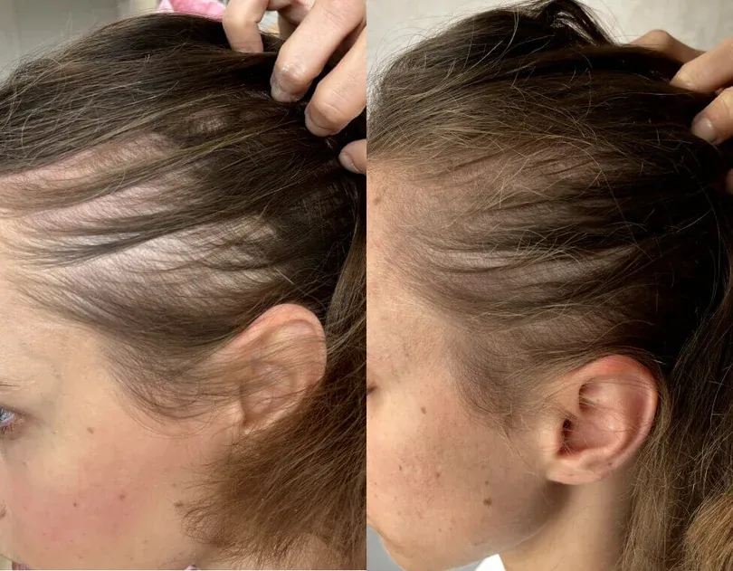 Supplied side-by-side photos of the side hairline